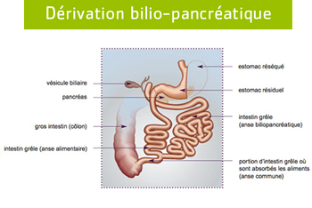 dérivation billion-pancréatique